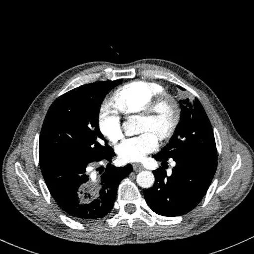 双肺多处空洞,病因竟不止一个