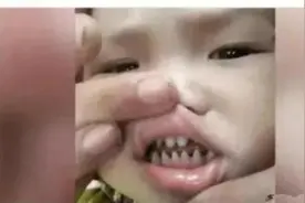 孩子长出“鲨鱼牙”，妈妈疑惑送医检查，医生叹息：家长太无知图片