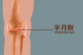 半月板出现囊肿的原因有哪些？应如何治疗？图片