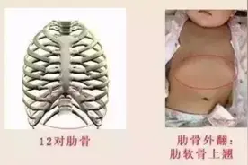 明明没有肚子，穿衣服愣是突出来一块，肋骨外翻为何如此惹人嫌图片