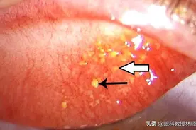 深圳26岁女子爱戴隐形眼镜，医生从她眼里剔出10几粒结石图片