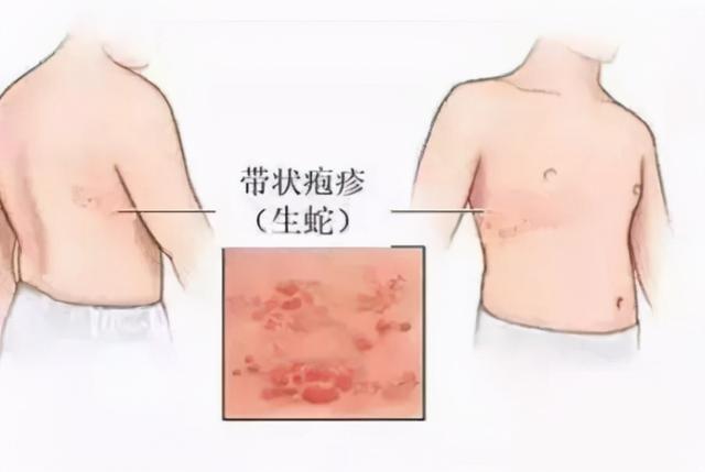 春季带状疱疹高发，专家：约五成患者遗留神经痛，简单4招可预防