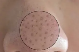 低成本，不伤皮肤，去除黑头只要10分钟，男生也可以用图片