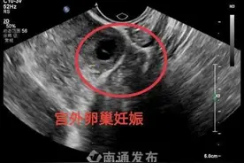 罕见！南通一女子宫内宫外竟同时怀孕图片