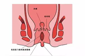 肛裂也分型？分类？图片