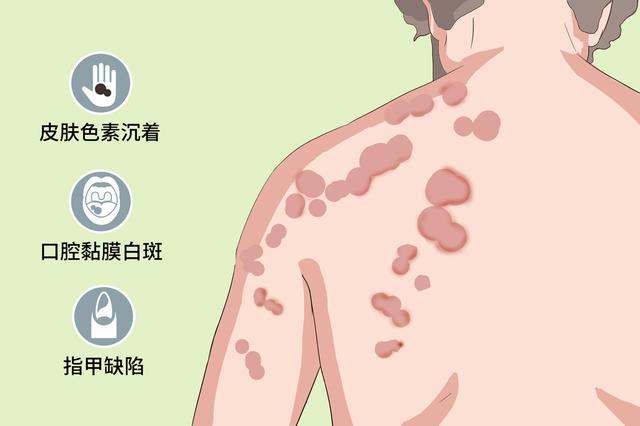 表面显示过度角化及角化不全