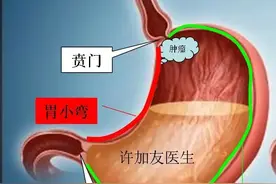 胃都切了，怎么吃饭？图片
