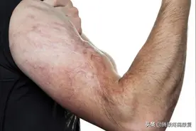 身体瘢痕带来的影响图片