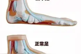 扁平足的自查方法图片