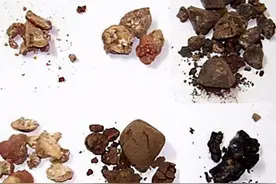 三金排石汤治“肾结石”1例，38岁，腰痛，腹部有包块，排尿疼图片