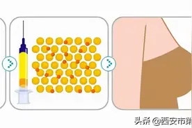 #安心变美课堂##我的安心变美推荐# 自体脂肪填充后，过段时间就会吸收代谢完吗？图片