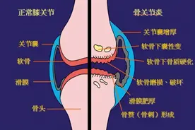 关节不好　服氨糖有用吗图片