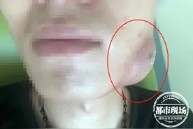 智齿发炎不重视，小伙脸上长出超大脓肿！医生：这些人尽早拔除图片
