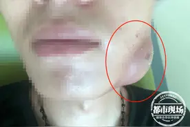 智齿发炎不重视，小伙脸上长出超大脓肿！医生：这些人尽早拔除图片