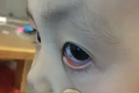 孩子眼睛里的眼白有“黑点”？爸妈不用惊慌，这3原因惹得“祸”图片