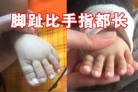 “脚趾”比手指长的宝宝火了，被赞：骨骼清奇，宝妈：不是好事图片