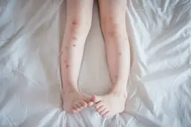 孩子被蚊虫叮咬，起了很多包怎么办？图片