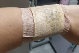 打科兴疫苗一个星期后手腕肿胀发麻图片