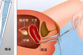 你知道吗？人工授精，助力好孕图片