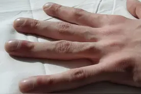 警惕！你的手指有这个特征吗？若符合，赶紧去做心电图图片