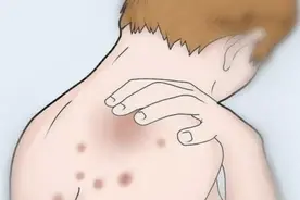 后背长的“小痘痘”到底是什么？这些战痘误区许多人都走过图片