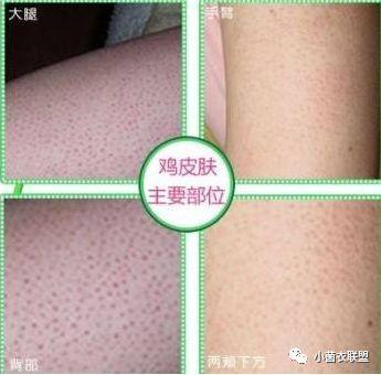 先天性鸡皮疙瘩