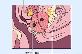 前列腺钙化导致“早泄”、脱发，早治疗可以减轻痛苦图片