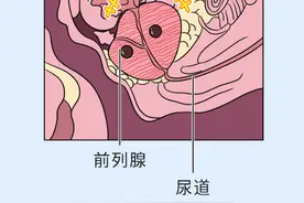 前列腺钙化导致“早泄”、脱发，早治疗可以减轻痛苦图片