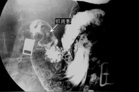 胃肠造影（RF）病例--精品图集图片