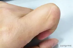 你的食指上，是否也有一道疤痕｜写篇杂文，科普一下图片