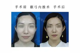 老气多边形脸秒变年轻气质鹅蛋脸图片