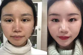 开了眼角后悔不已的案例：内眼角过大、露红、括号、疤痕重、显假图片