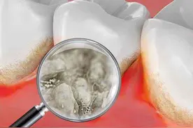 什么情况下才能拔牙？牙齿不是疼了就可以拔的，这些方面要注意图片