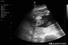 什么是“阴式”B超？检查需要哪些步骤？建议男女都了解一下图片