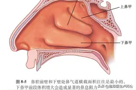 什么是阔鼻畸形？应该如何进行矫正？图片