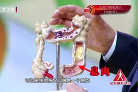 息肉是癌症的前兆？到底要不要切？收好这份判断标准图片