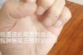 腰肌筋膜炎的针刺治疗图片