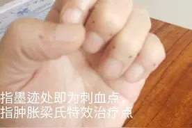 腰肌筋膜炎的针刺治疗图片