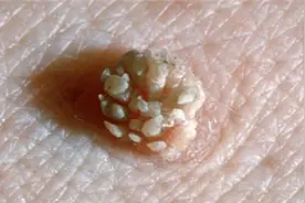 怀疑长了尖锐湿疣，为什么要做醋酸白试验？医生教你做筛查图片