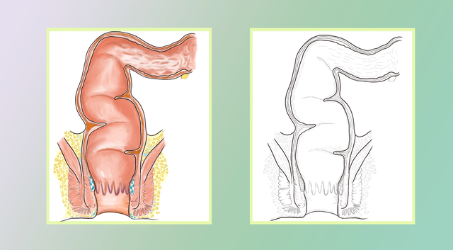芳香L-氨基酸脱羧酶缺乏症是一种罕见的，由多巴脱羧酶缺陷引起的