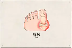 痛痛痛！来吧，戳视频，答题｜全民关注痛风日图片
