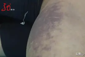 危险危险危险！男子上山遇到意外，小腿布满黑紫色瘀斑图片