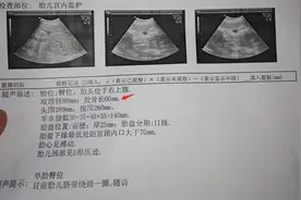 产检时胎儿“股骨短”，意味着孩子是矮个子吗？背后原因很复杂图片