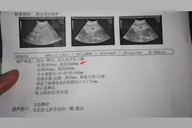 产检时胎儿“股骨短”，意味着孩子是矮个子吗？背后原因很复杂图片