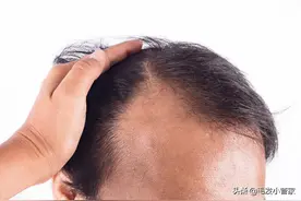 植发后会留下后遗症吗图片