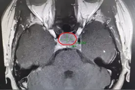 【都是垂体惹的祸（二）】不孕不育、不来例假，不要忽视垂体泌乳素腺瘤！图片