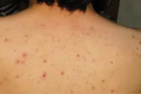 毛囊炎没得救？皮肤科主任推荐：3个便宜又好用的药，消除不反复图片