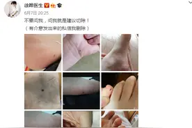 你的身上有痣吗？符合6个特征，十有八九是黑色素瘤，要及时切除图片