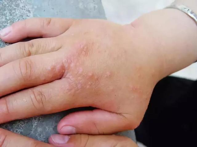 指端角化性类弹性纤维病