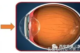 【眼科知识】近视的形成图片